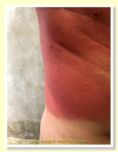 Sunburn in Thailand Sunburn in Thailand